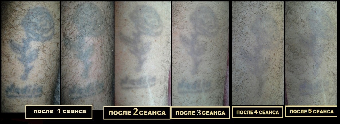 Свод тату. Удаление татуировок лазером. Сведение Татуировки до и после. Лазерное удаление тату до и после.